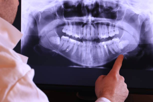 Best Emergency Wisdom Teeth Removal in New Ellenton, SC